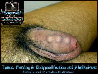 Beading-Implantat-Intim-Penis-Piercing-Bodymod-by-Bodyship-Halle---Sachsen-Anhalt---www.bodyship.de