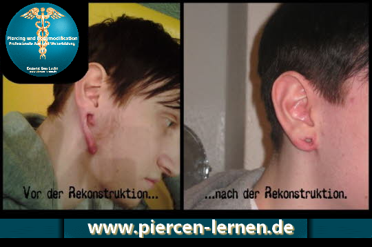 Ohr Tunnel gerissen Rekonstruktion wieder zusammen nähen modsbyben bodyship piercen-lernen
