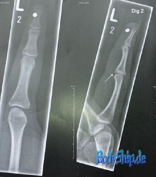 Magnetimplantat Röntgenbild Bodymodification Galerie - professionell bodymodification und piercen-lernen