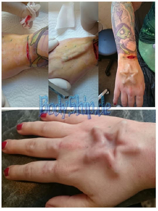 Stern Implantat Bodymodification Galerie - professionell bodymodification und piercen-lernen