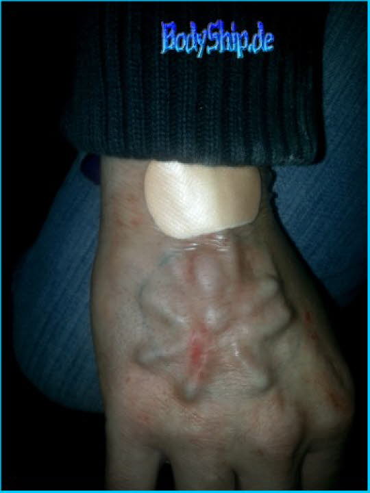 Subdermal-Silikon Spider Spinne Implantat Bodymod by Ben - bodymodification und piercen-lernen