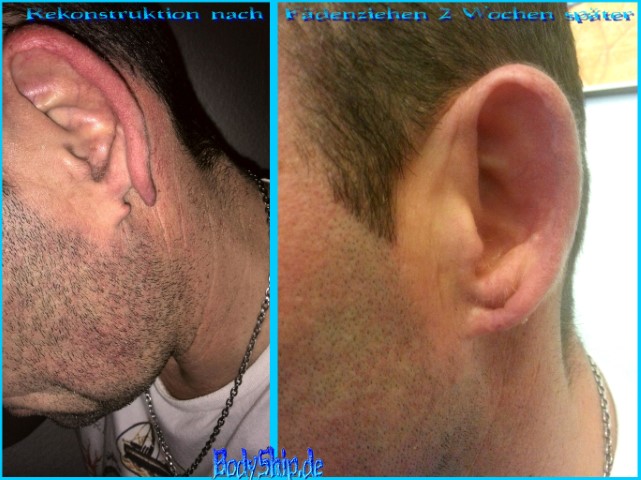 Ohrloch gerissen rekonstruieren oder Tunnel Loch nähen lassen Operation - Cutting, Implantate, Beadings Zungenspaltung sowie Piercing Ausbildung, Piercer werden, Piercing Kurs, Piercer Seminar und Bodymods lernen auf piercen-lernen.de #modsbyben 