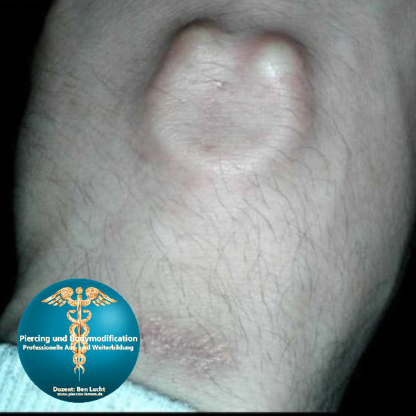 subdermales Hufeiesen Silikon Implantat Bodymodification Deutschland Ben Lucht piercen und bodymodification lernen #modsbyben